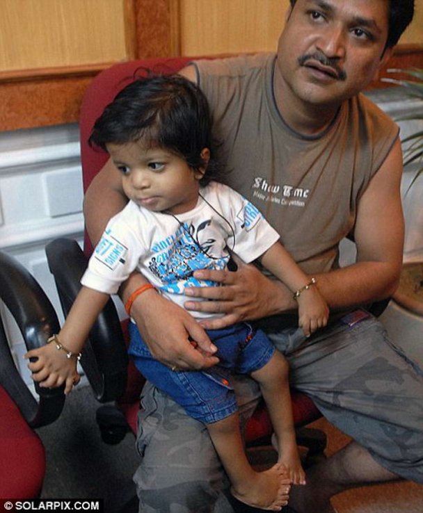 Рекордное количество пальцев у ребенка