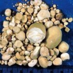 В Индии мужчине удалили рекордное количество камней в почках