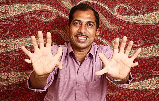 Девендра Сутар: человек с наибольшим количеством пальцев на руках и ногах