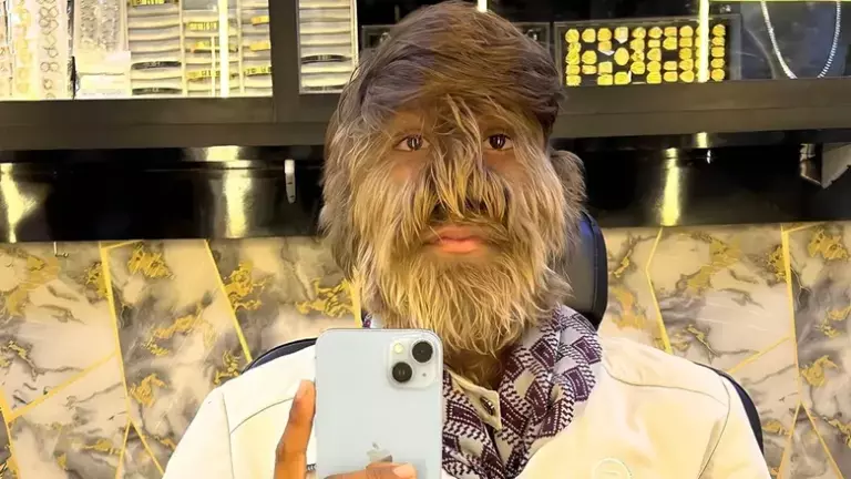 Самое волосатое лицо мужчины: Лалит Патидар (Индия)